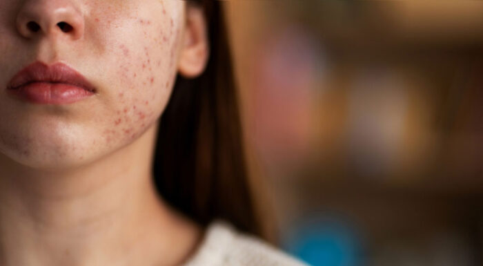 More Than Just Fatigue: Shedding Light on Lupus, the Invisible Illness