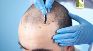 How to Choose the Right Hair Transplantation Centre?
