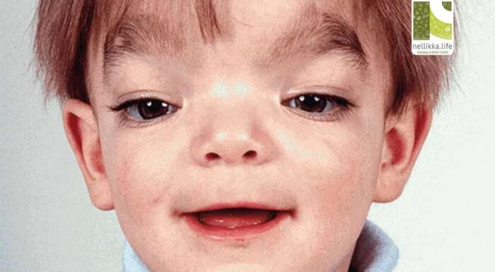 Understanding Aarskog Syndrome: A Rare Genetic Puzzle