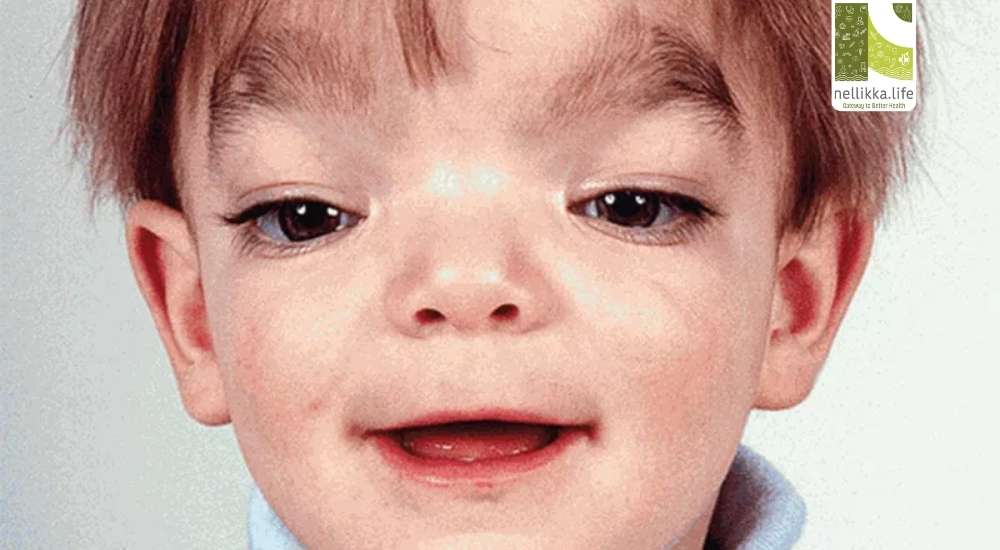 Understanding Aarskog Syndrome: A Rare Genetic Puzzle