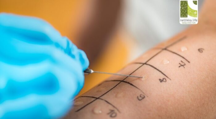 What is an Allergy Test? Everything You Need to Know