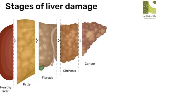 What is Non-Alcoholic Liver Cirrhosis?