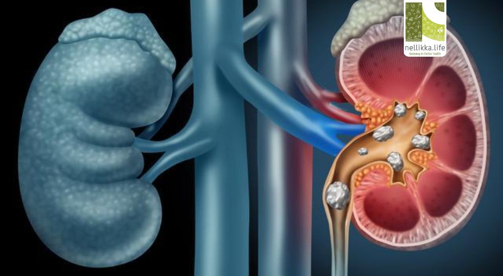 Kidney Stones: Causes, Symptoms, Diagnosis, Treatment & Prevention