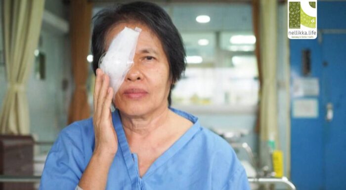 Post-Operative Eye Care After Cataract Surgery