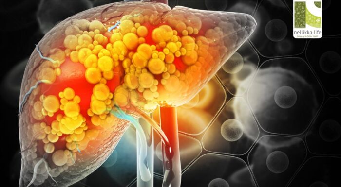 Fatty Liver Disease (NAFLD): The Silent Epidemic Threatening Millions