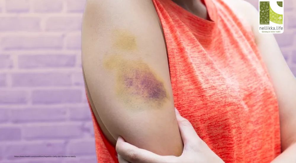 First Aid for Bruises — What To Do Immediately Before Going to the Hospital