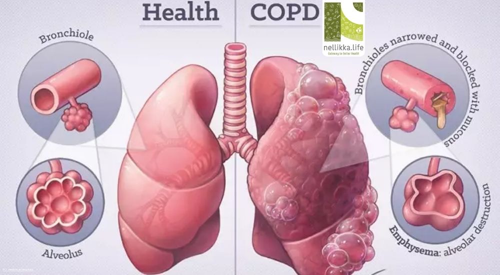 Understanding COPD: The Disease That Slowly Steals Your Breath