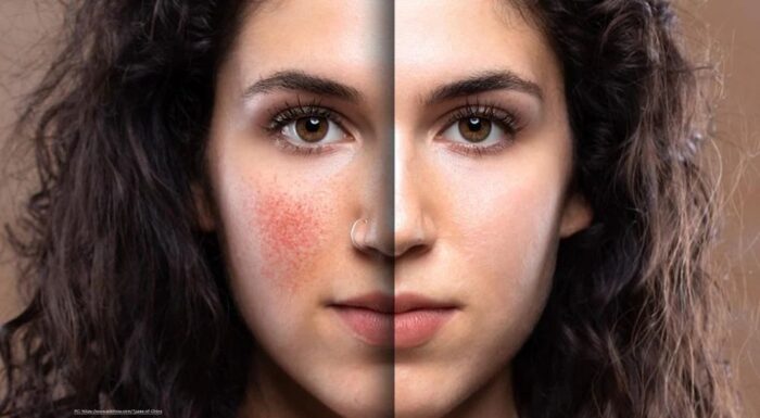 Eczema: Understanding, Managing, and Living Beyond the Itch