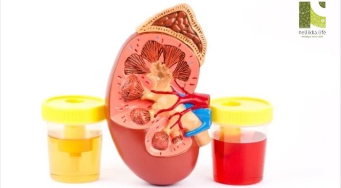 When Your Urine Turns Red: Understanding Blood in Pee (Hematuria)