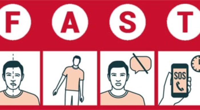 Can We Know If We’re About to Have a Stroke?