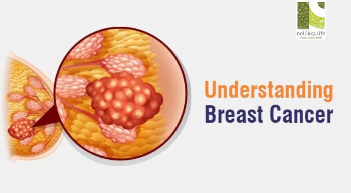 What Is Breast Cancer? Understanding the Disease, Its Causes, and Early Warning Signs