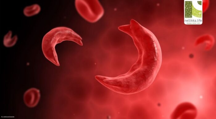Sickle Cell Disease: Know It to Beat It