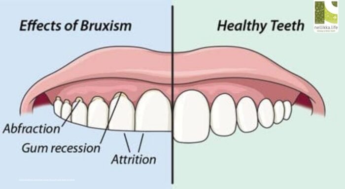 Bruxism: How Nighttime Teeth Grinding Wrecks More Than Your Smile