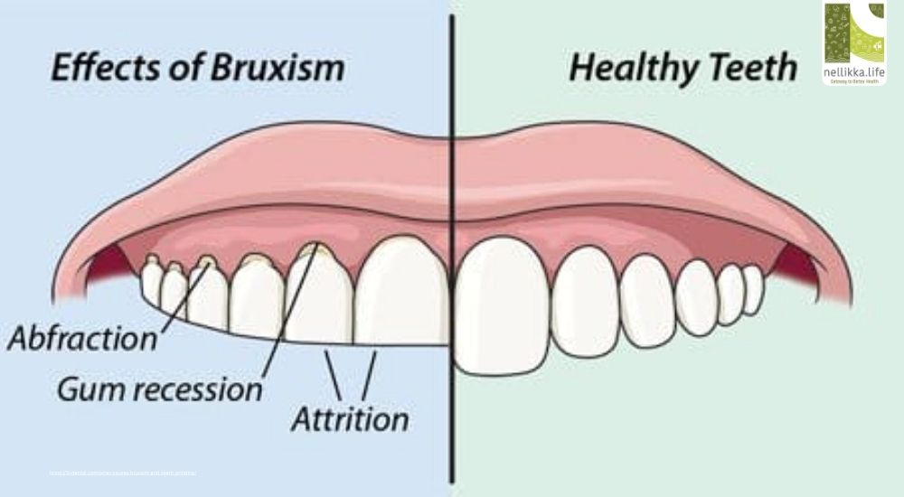 Bruxism: How Nighttime Teeth Grinding Wrecks More Than Your Smile