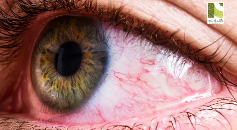 Itchy, Watery, Red: Understanding Urban Eye Allergies