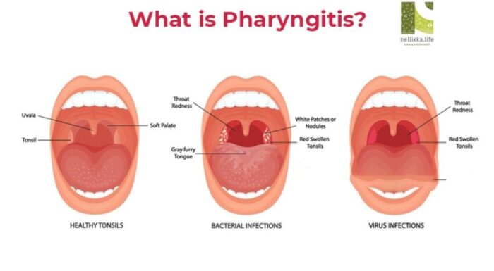 Sore Throat (Pharyngitis): Causes, Symptoms, and Science-Backed Care
