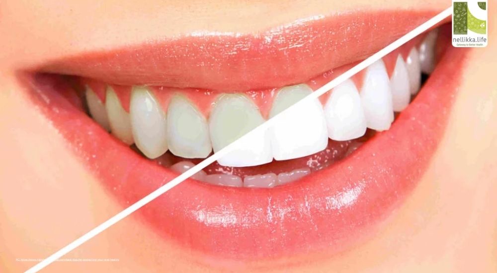 Whitening or Weakening? The Truth About Teeth Whitening Treatments