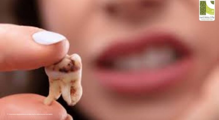 The Cavity Trap: Why Tooth Decay Isn’t Just About Sugar