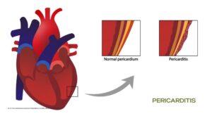 Pericarditis: When the Heart’s Shield Turns Against Itself