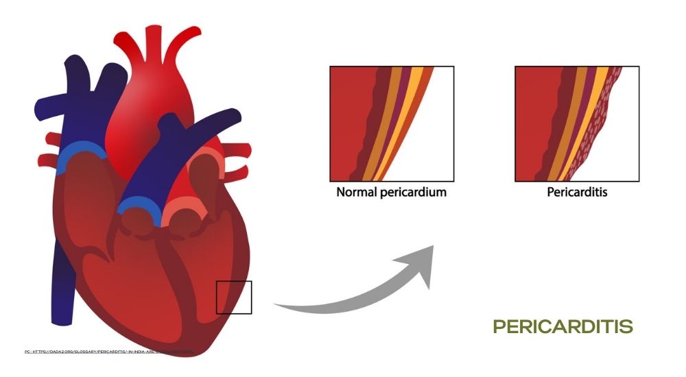 Pericarditis: When the Heart’s Shield Turns Against Itself