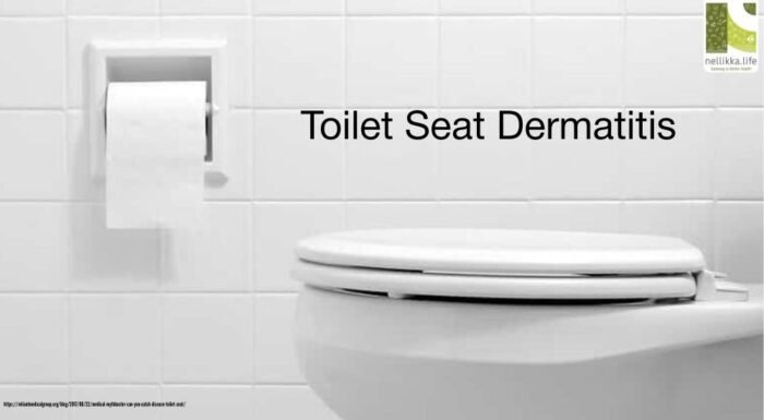 Toilet Seat Dermatitis: A Hidden Hygiene Hazard You Shouldn’t Ignore
