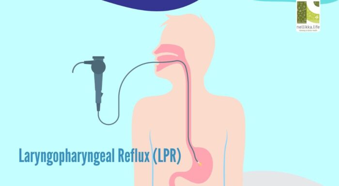 The Silent Burn — When Acid Reflux Attacks Your Throat Without Heartburn