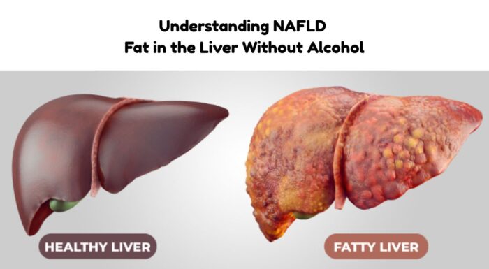 Why Young Adults Are Getting Fatty Liver Without Alcohol
