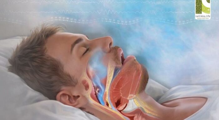 Sleep Apnea in Non-Obese People: The Overlooked Sleep Disorder