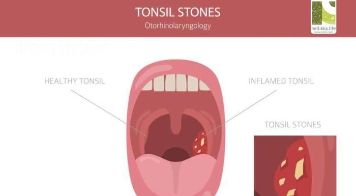 Chronic Tonsil Stones: The Hidden Cause of Bad Breath and Throat Discomfort