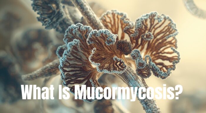 Mucormycosis (Black Fungus): A Serious but Preventable Fungal Infection